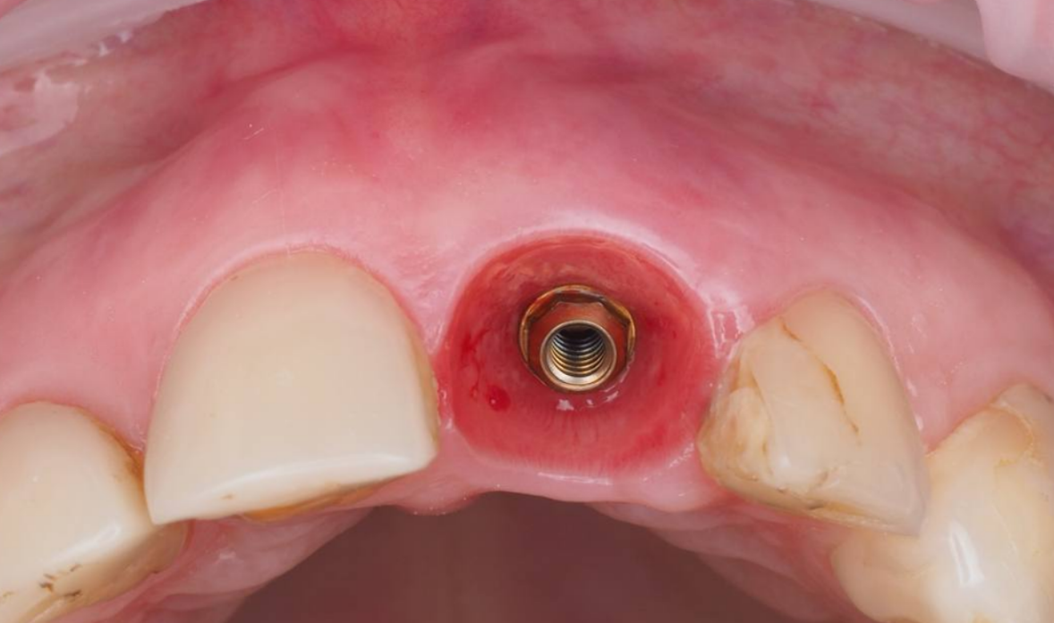 профиль прорезывание и состояние десны