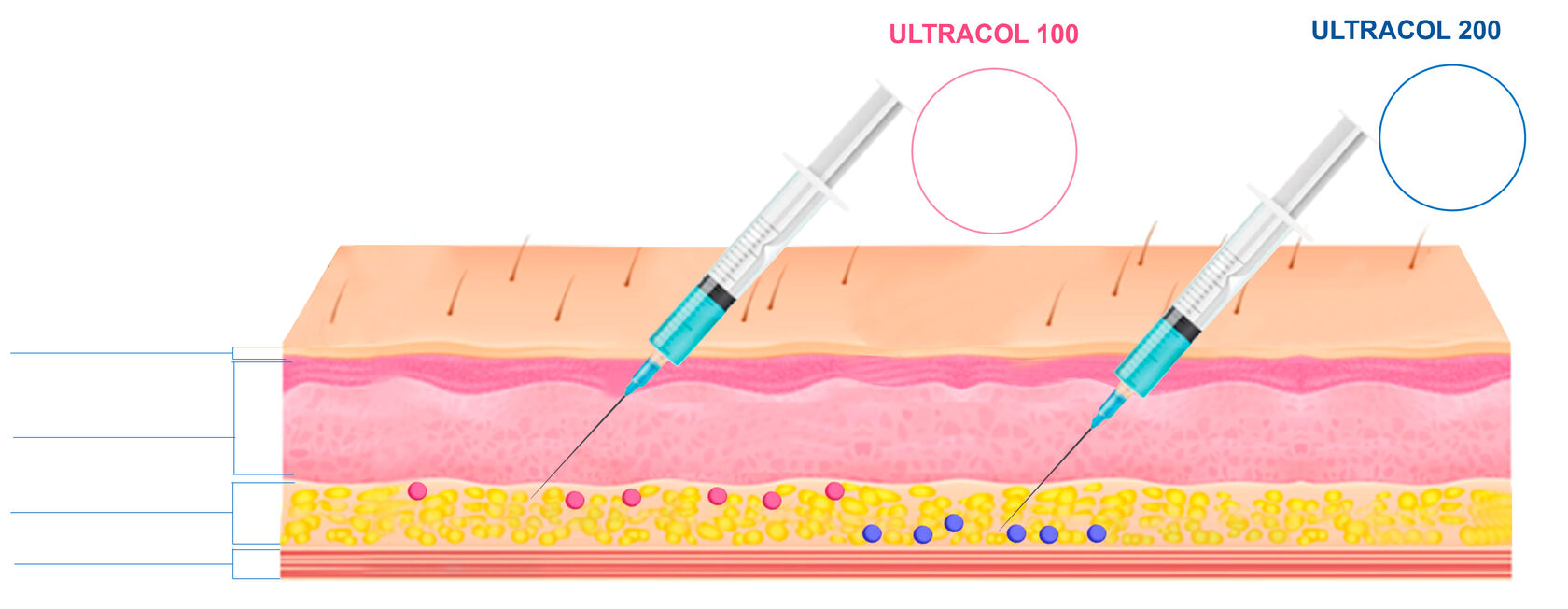 Ultracol - филлер на основе полидиоксанона