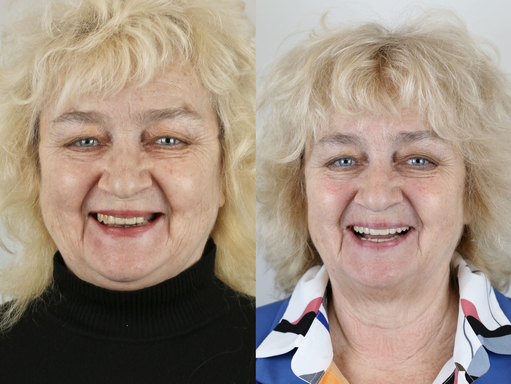 Как сохранить зубы здоровыми после 40, 50 и 60 лет