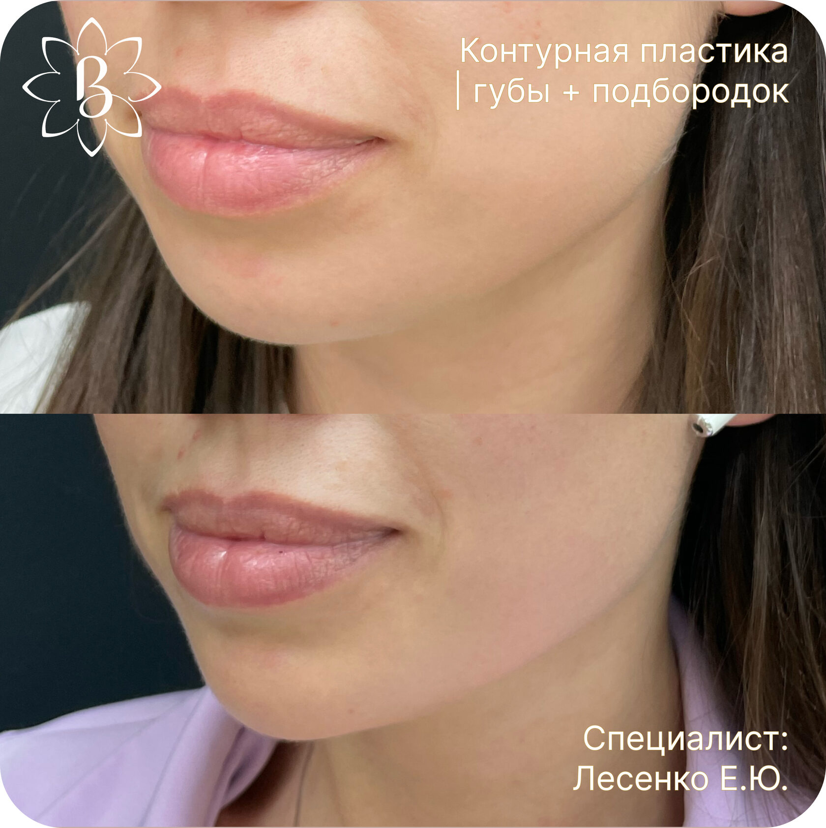 Александритовая лазерная эпиляция