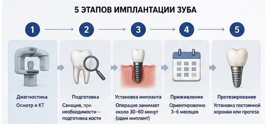 Этапы имплантации зубов в Реутове от диагностики до постоянной коронки