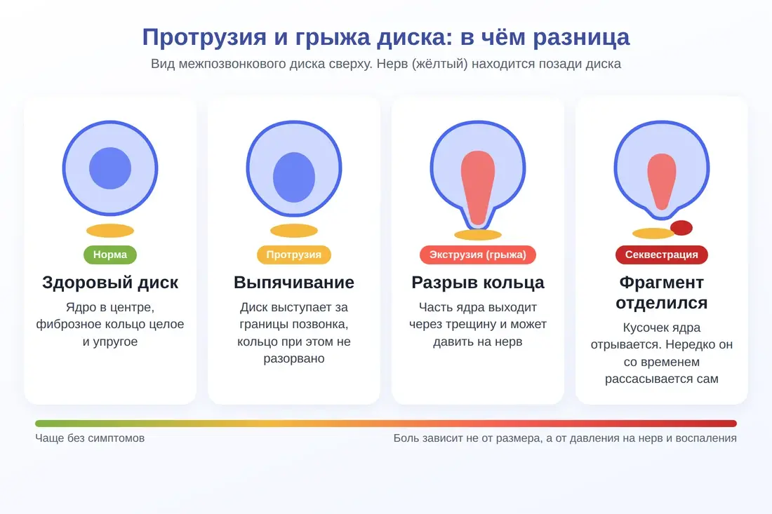 Схема: здоровый диск, протрузия, экструзия и секвестрация межпозвонкового диска