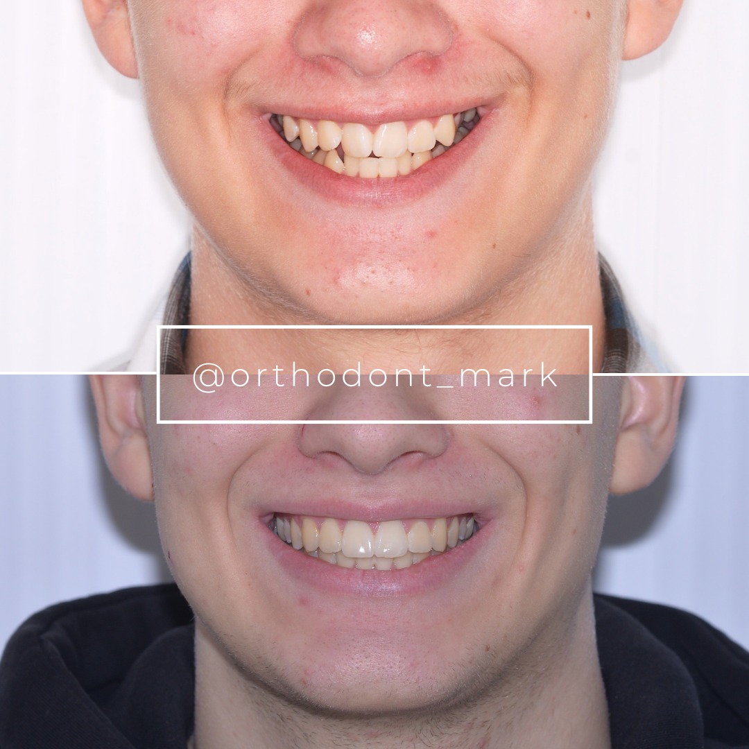 Before photo showing severe deep bite, crowding, and second-molar crossbite — photo 1 of 3