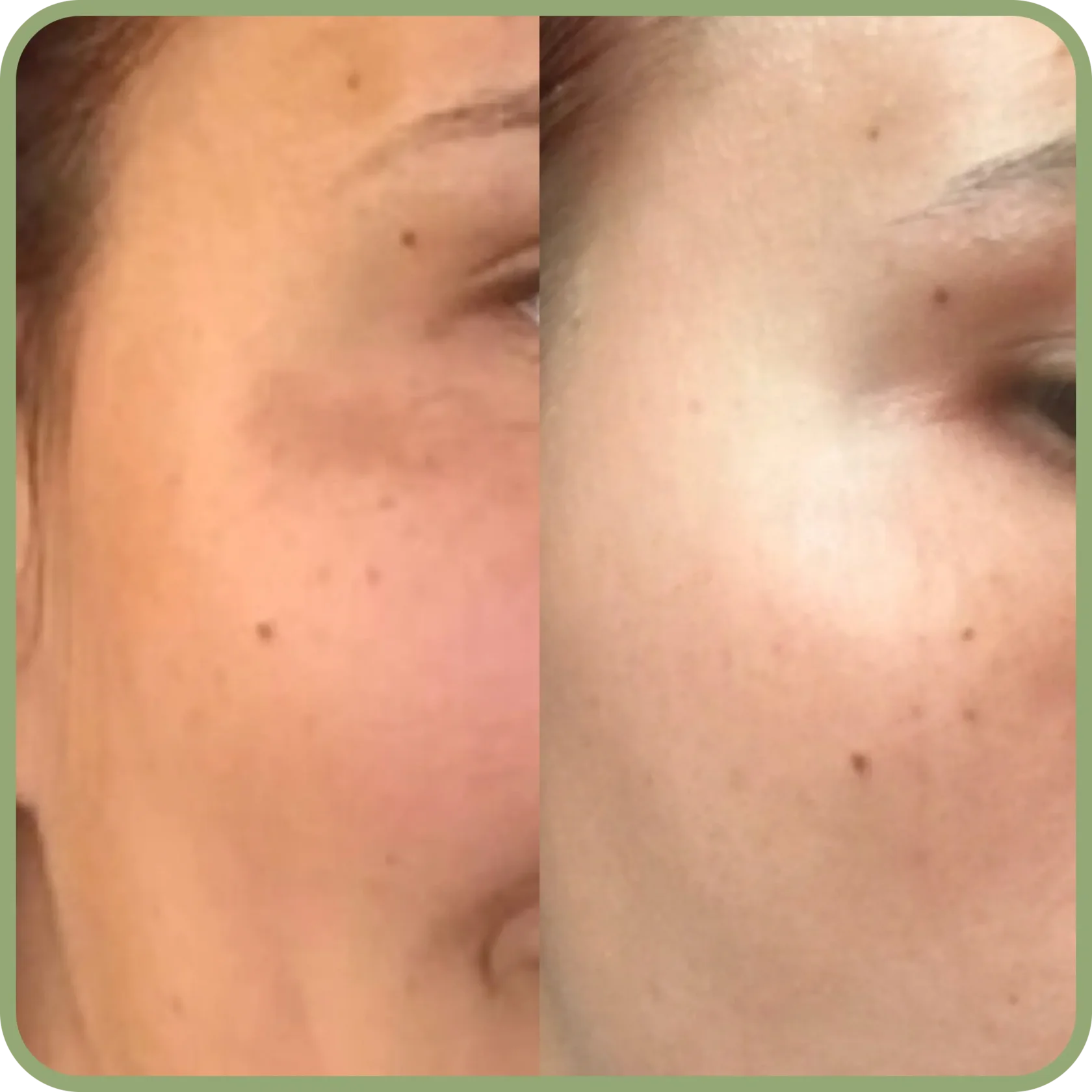 Результат химического пилинга в клинике Uniqderm