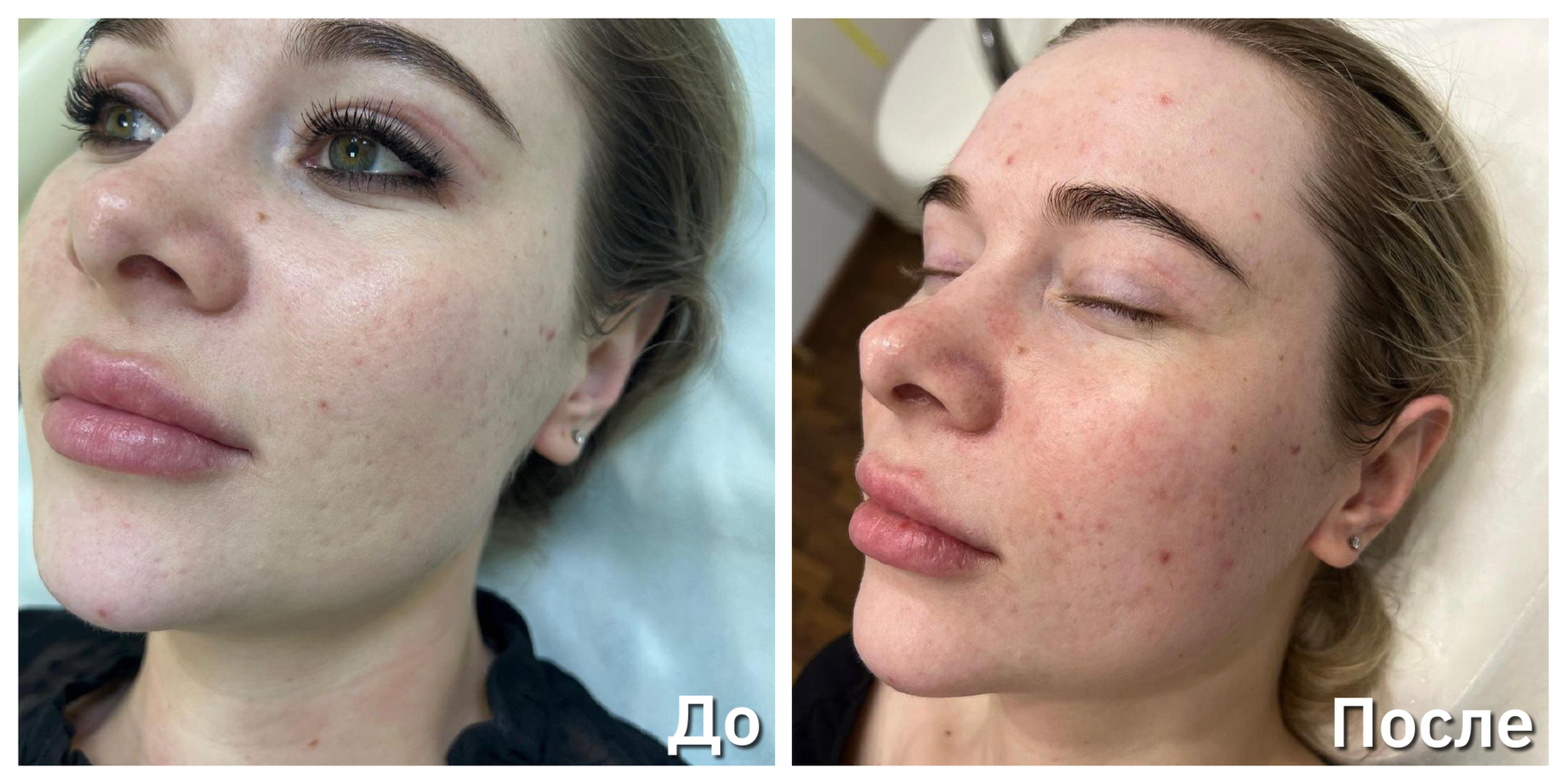 Фотодинамическая терапия REVIXAN - оборудование ФДТ и учебные курсы ...