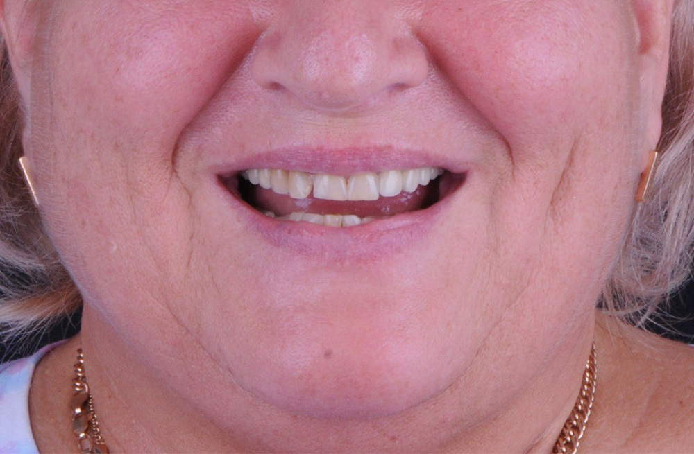 Замена металлокерамических реставраций на цельноциркониевые с опорой на импланты