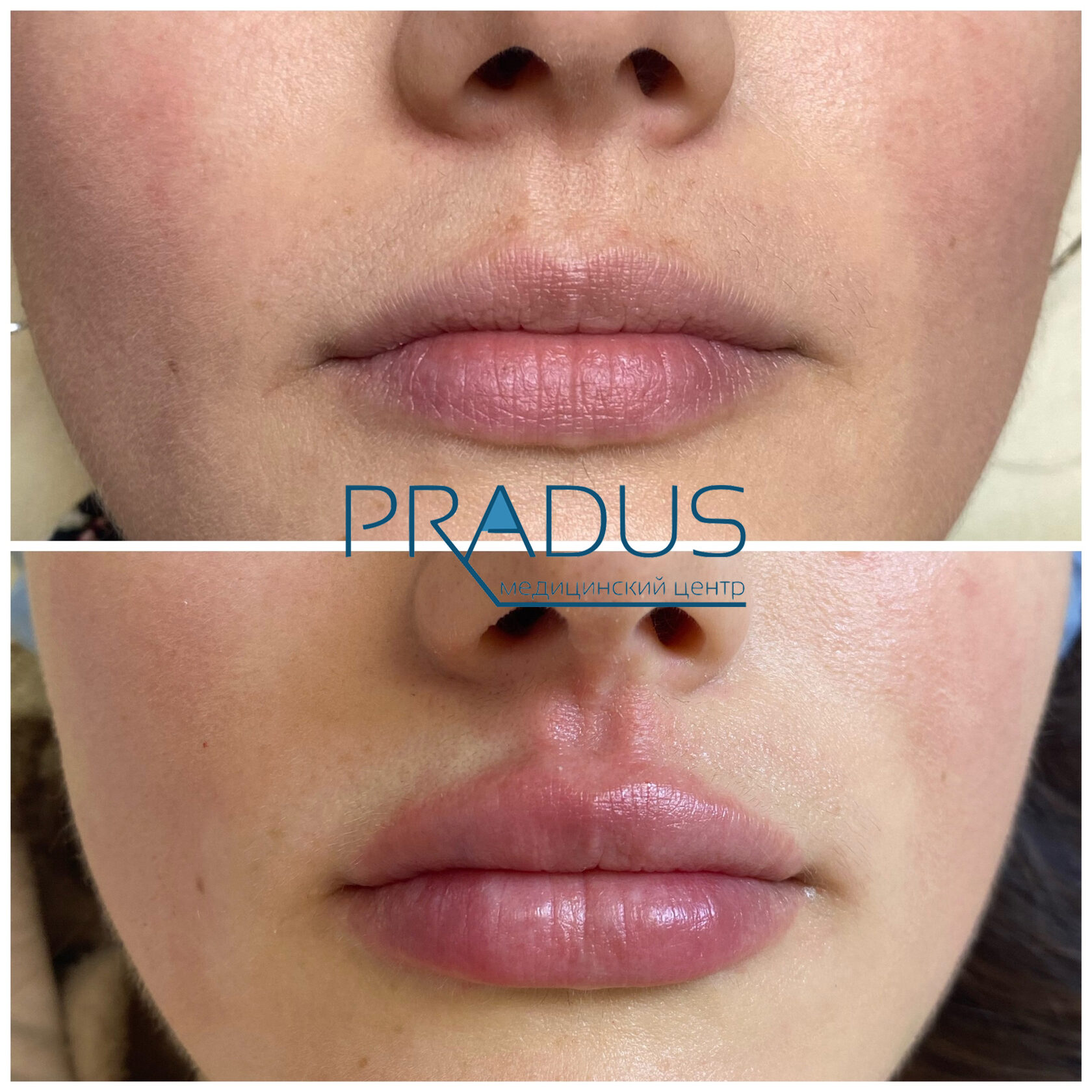 До и после контурной пластики губ. Увеличение объёма без утяжеления. PradusCOSMO, Васильевский остров