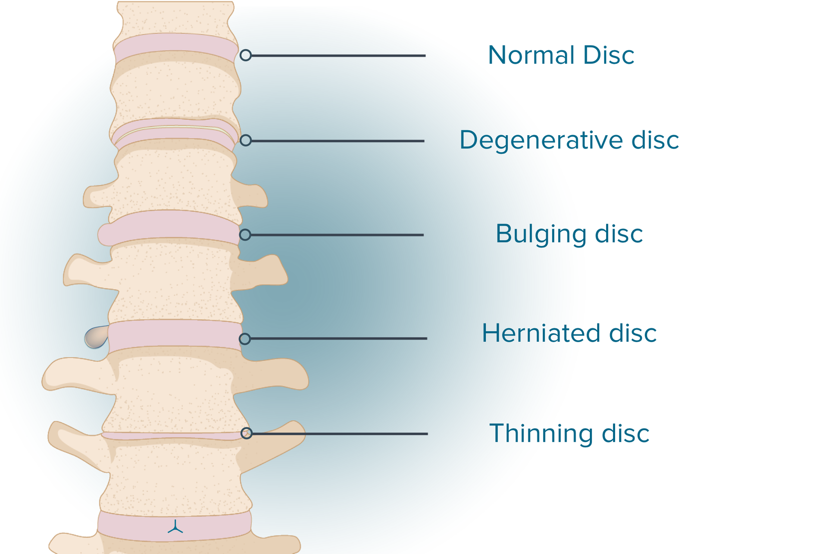 bulging-disc-l4-l5-guide-treatment-causes-and-symptoms