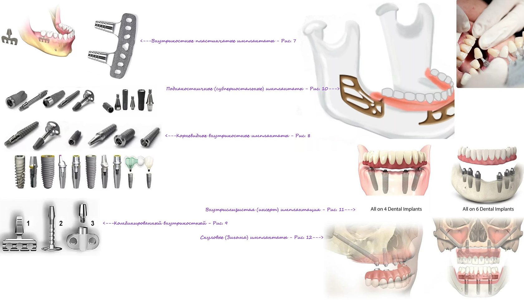 Как ставят импланты зубов по этапам фото пошагово