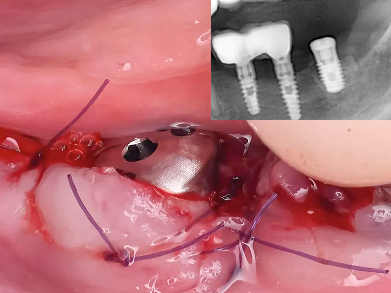 короткий имплант AnyOne Onestage