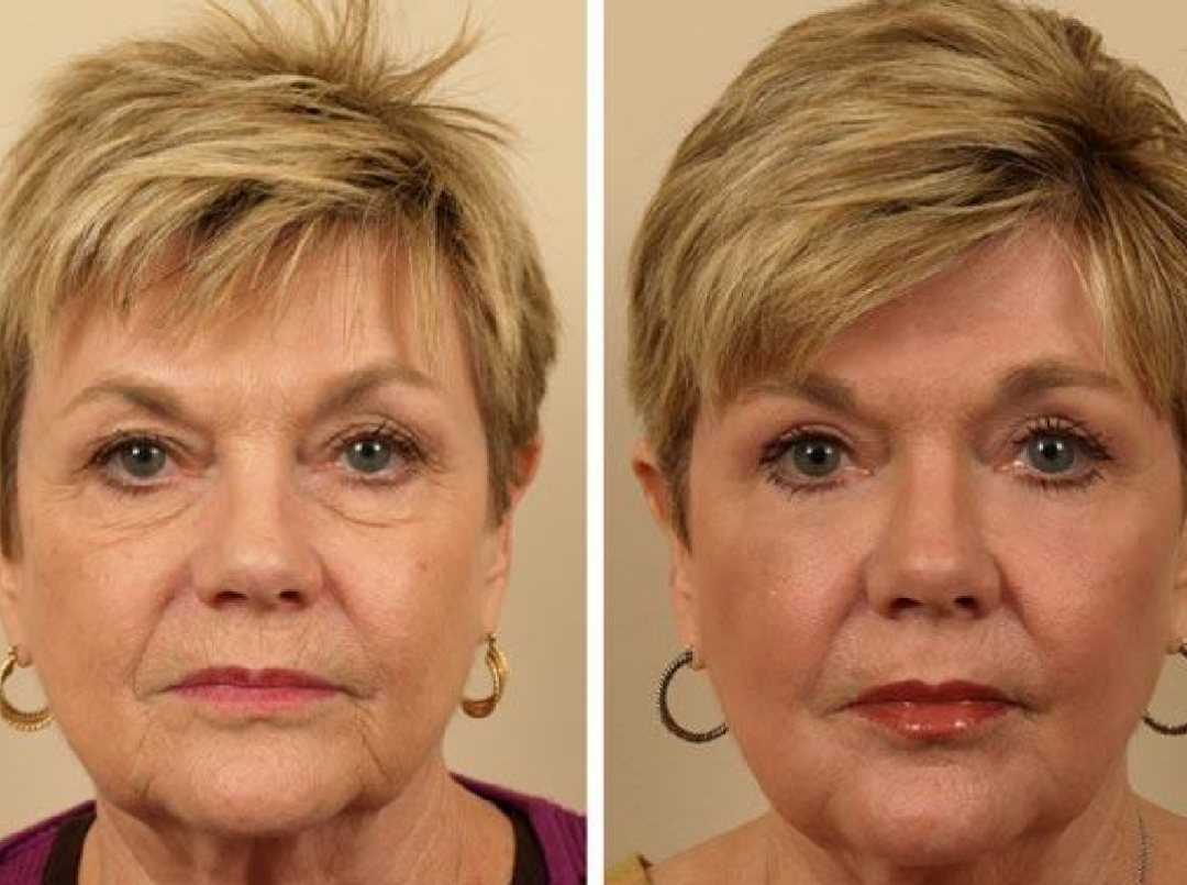 Омолаживающий массаж лица до и после. Подтяжка лица до и после. Лифтинг массаж лица до и после. Реальная подтяжка