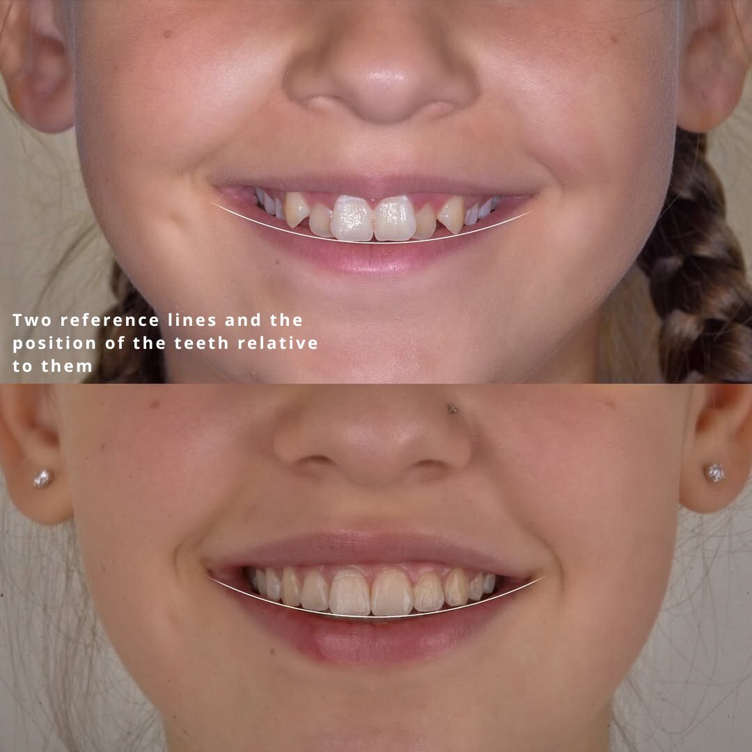 Mid-treatment view showing arch expansion and progressive alignment of crowded teeth — photo 2 of 3