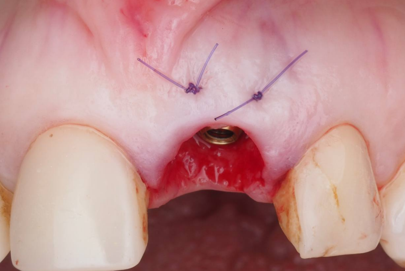 пластика десны во фронтальном отделе