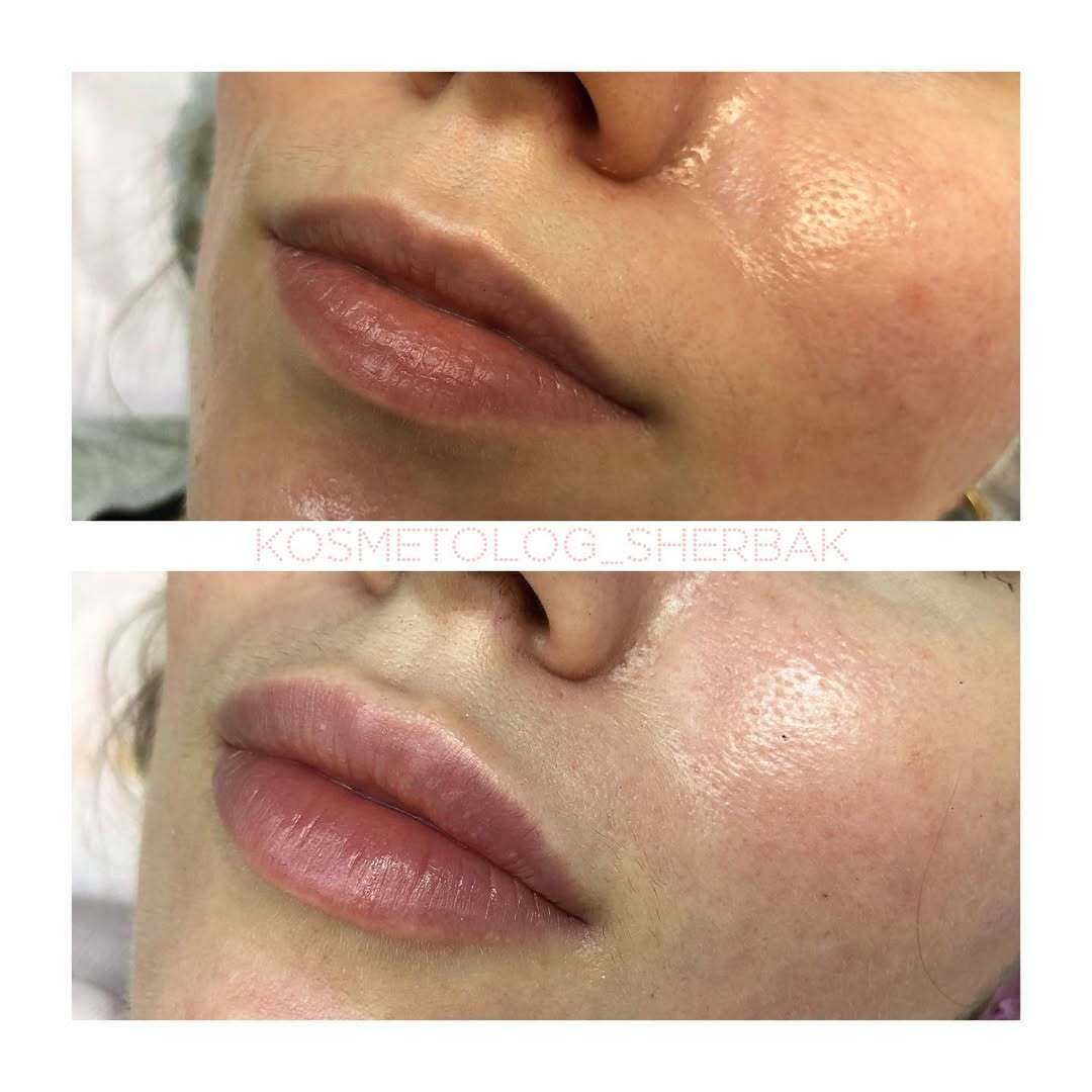 До и после контурной пластики губ. Увеличение объёма без утяжеления. PradusCOSMO, Васильевский остров