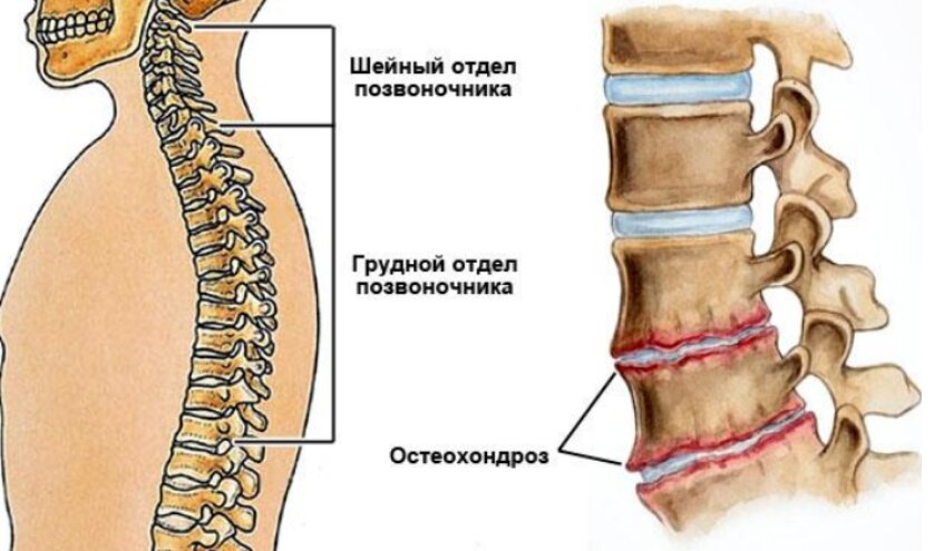 Остеохондроз армия