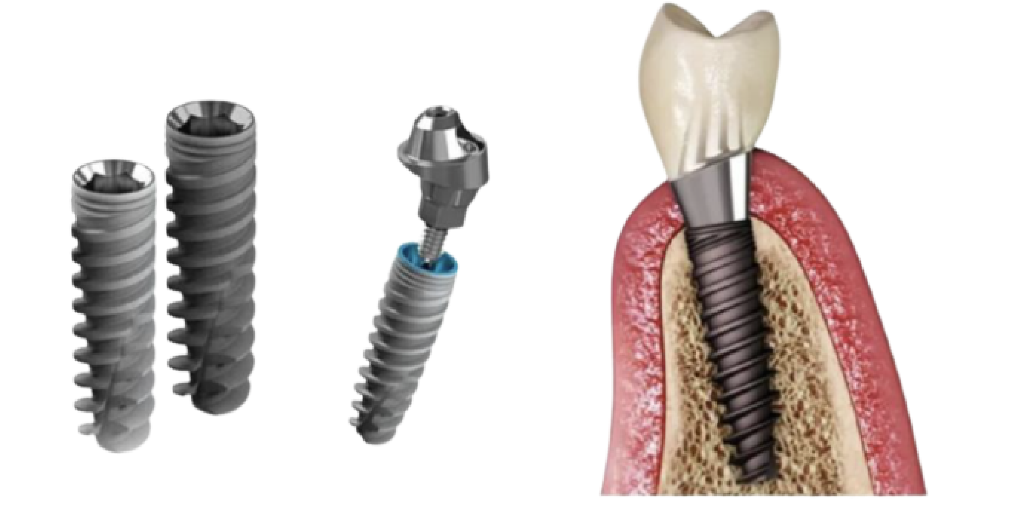 Виды имплантов. Имплантат r4206. Корневидные имплантаты. Трансоссальные имплантаты. Корневидный зубной имплант.