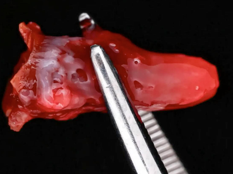 удаление зуба