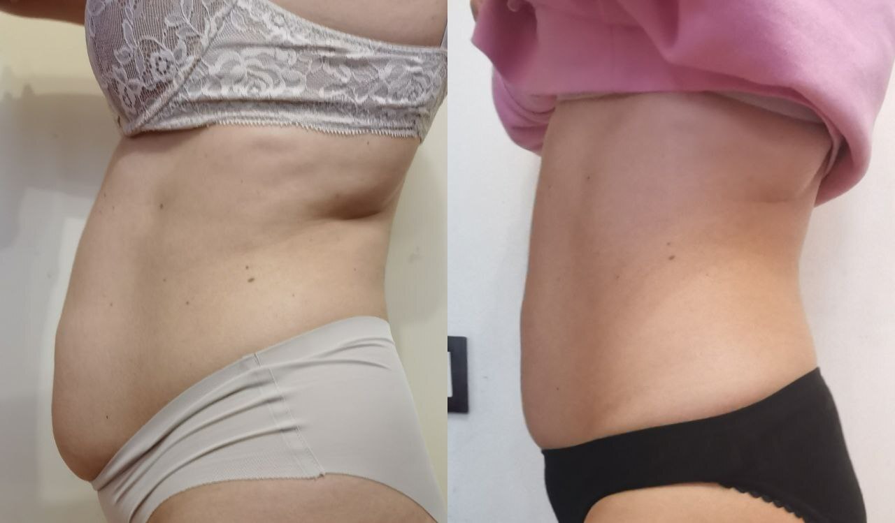 убрать_живот_после_родов