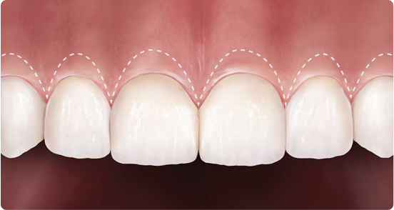 Гингивопластика — этапы процедуры и цены в Дербенте. Стоматология DK