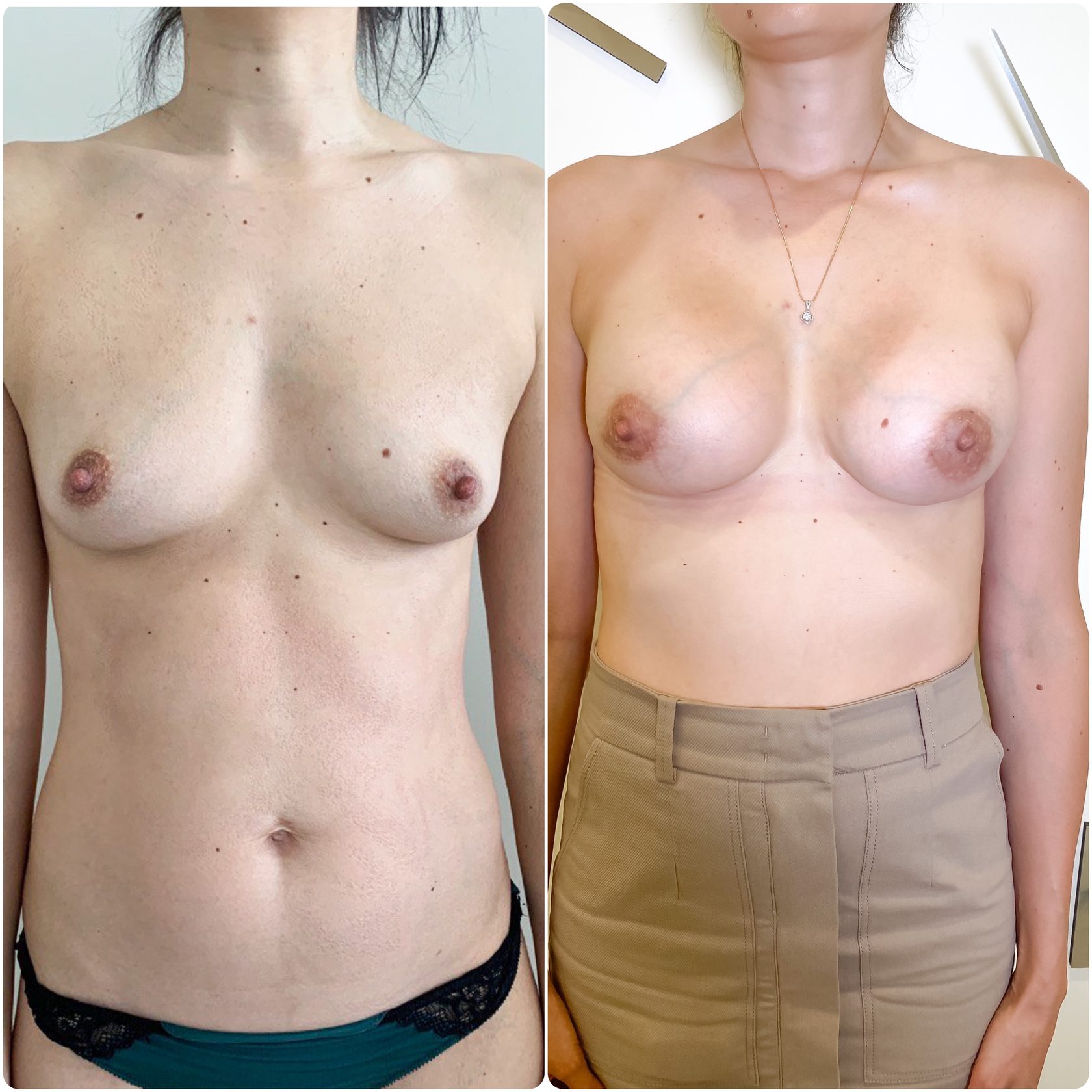 удаление импланта груди у женщин фото 104