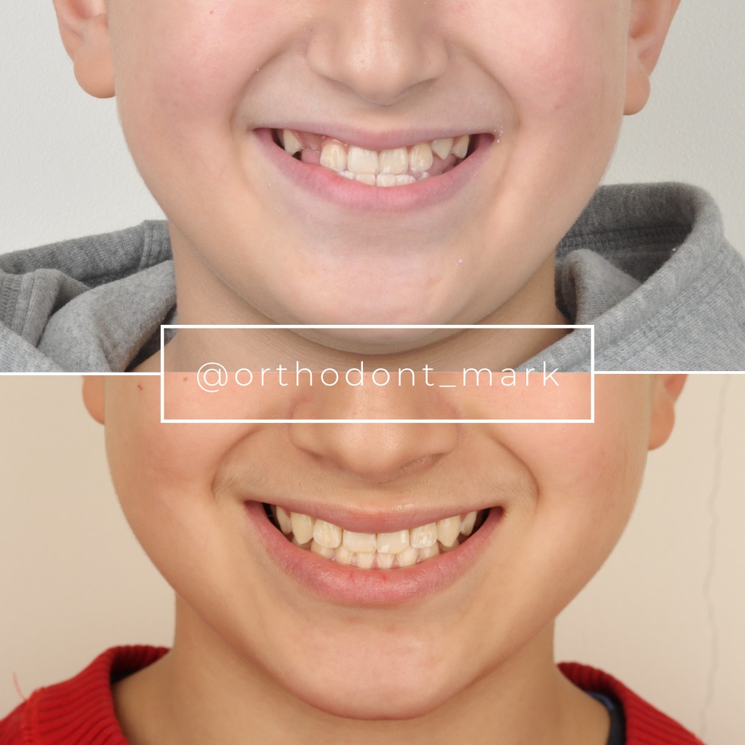 Before treatment view showing mesial bite with reverse anterior overlap — photo 1 of 7