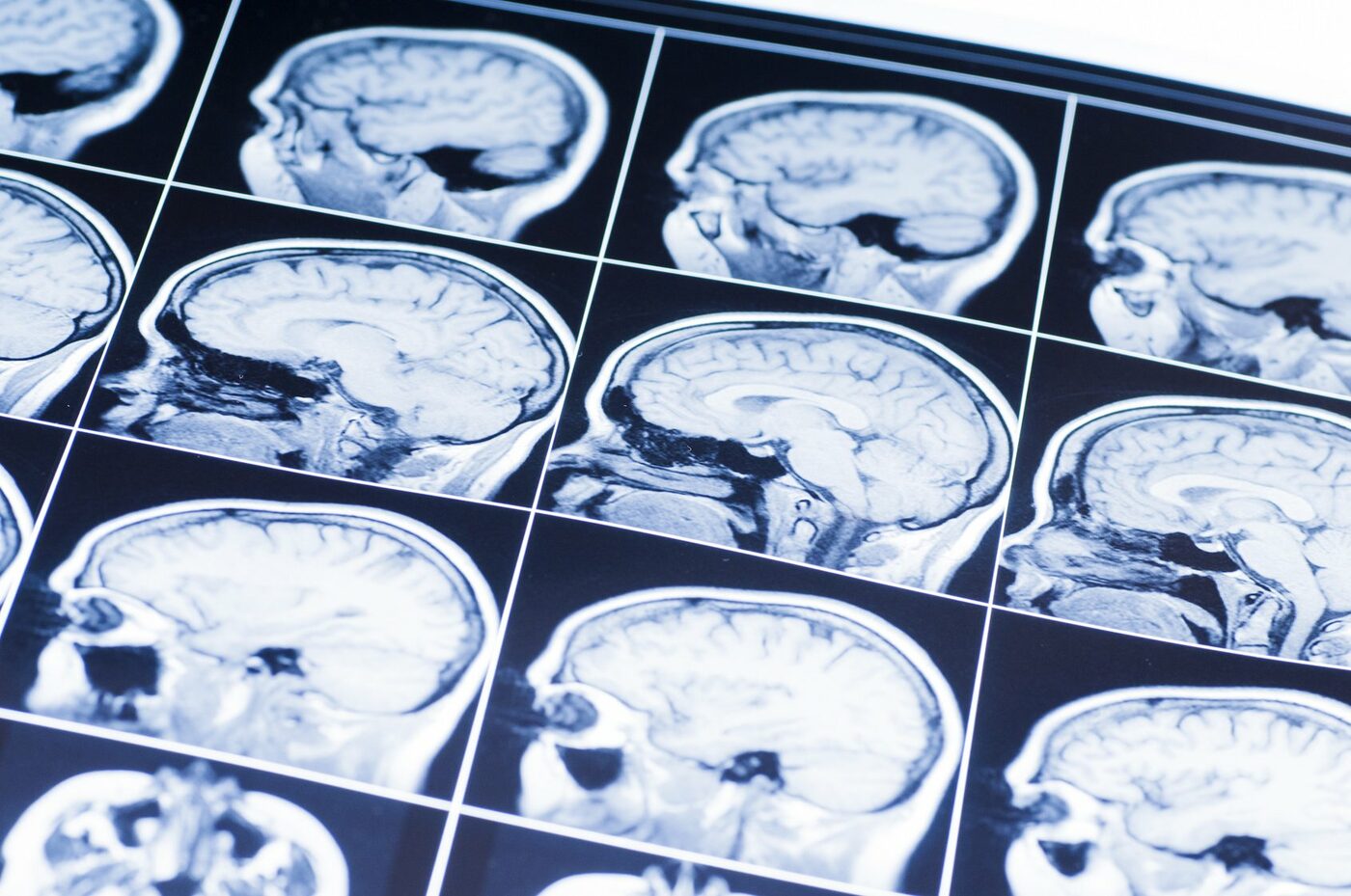 Что показывает МРТ головы?