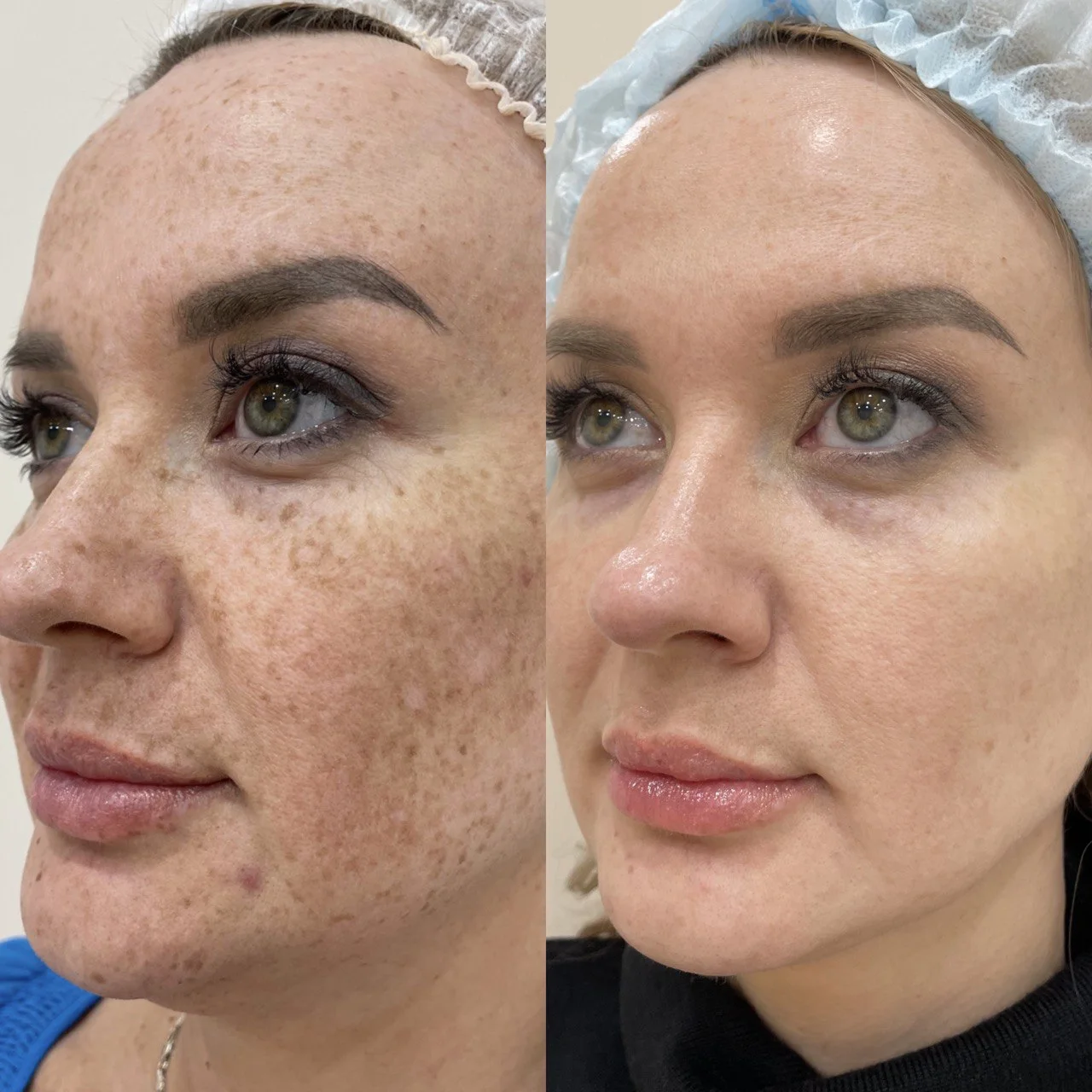 Лазерная шлифовка лица, цены в Казани – шлифовка кожи лазером в клинике |  СкинМед