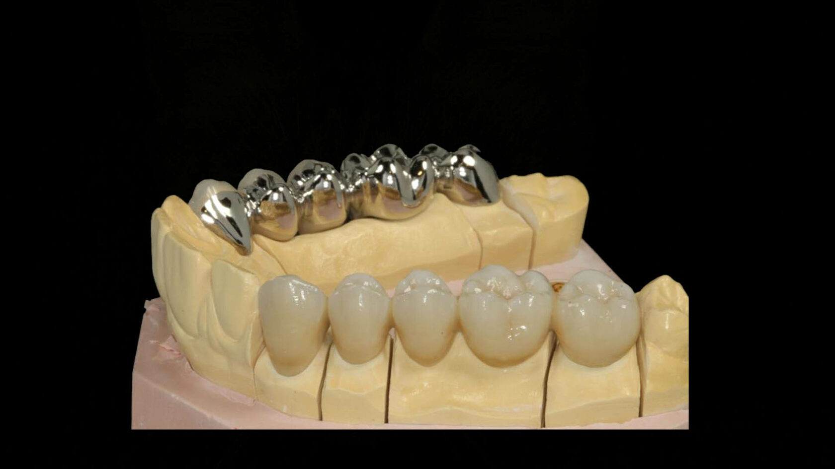 керамические мосты для зубов