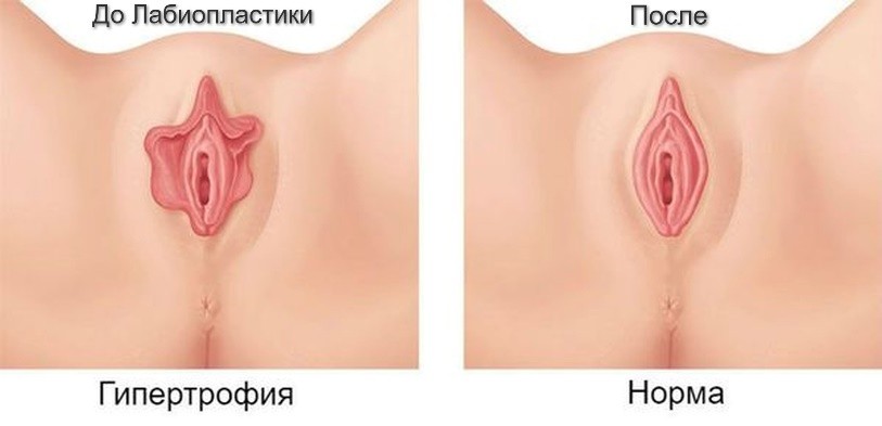 Схема: малые половые губы до и после лабиопластики