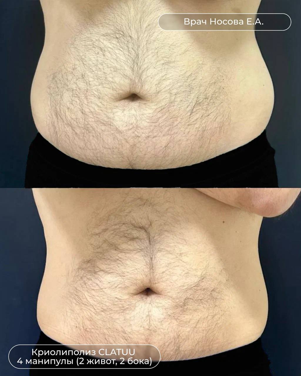 RF-лифтинг - До и После