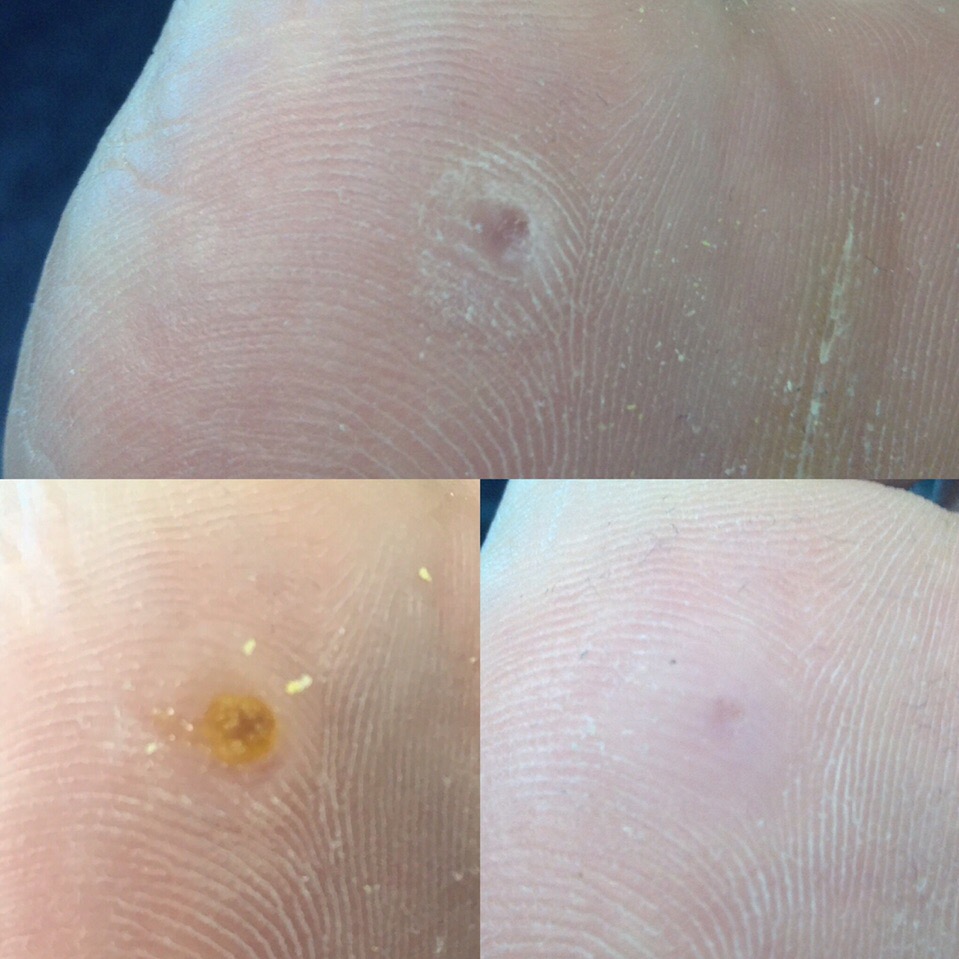 Устранение бородавки на ноге