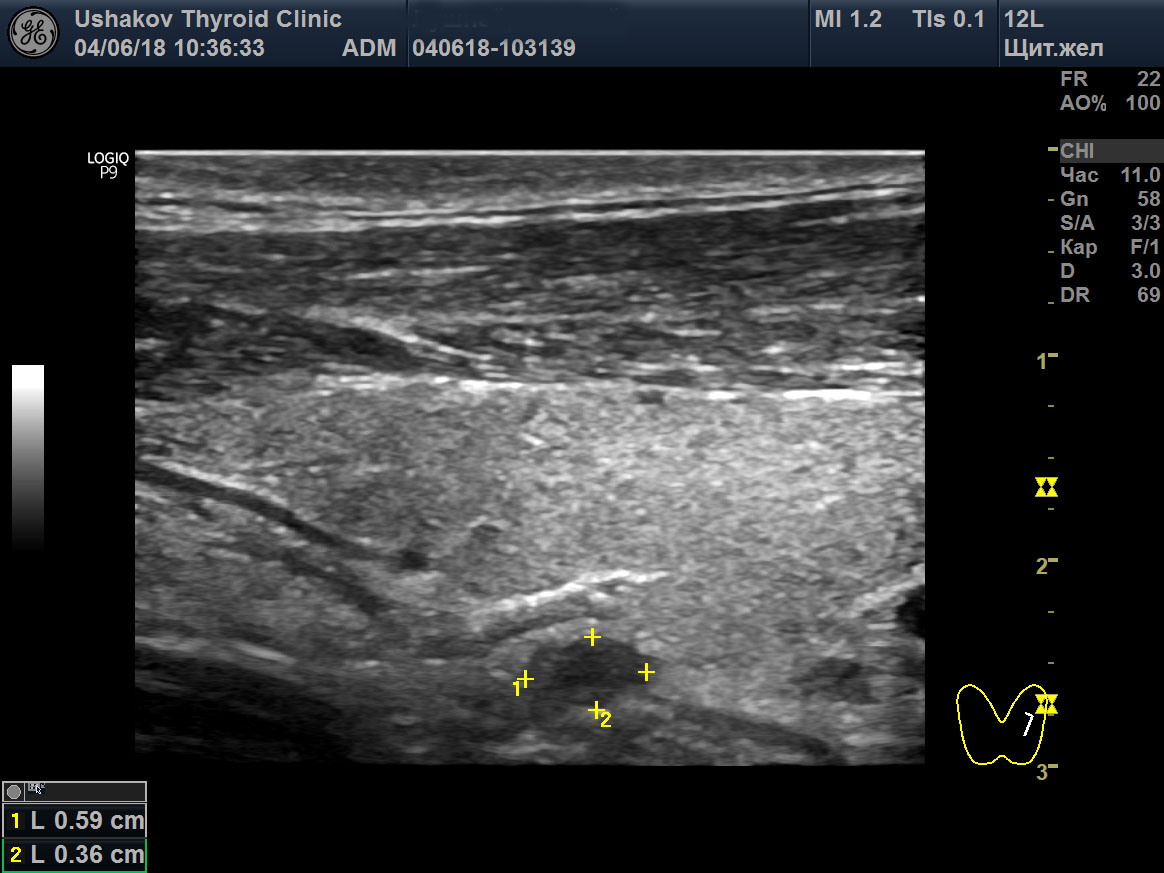 Узи железы. Паращитовидные железы на УЗИ норма. Аденома паращитовидной железы на УЗИ протокол. Узел паращитовидной железы на УЗИ. Паращитовидные железы УЗИ диагностика.