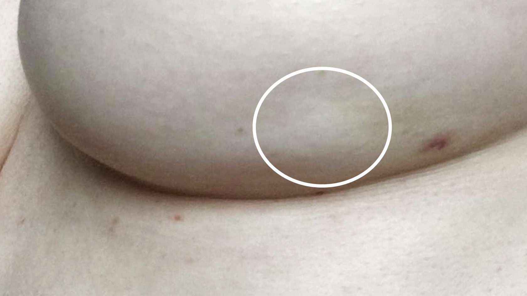 сухая кожа на груди при беременности (120) фото