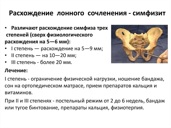 Симфизит при беременности как определяет врач