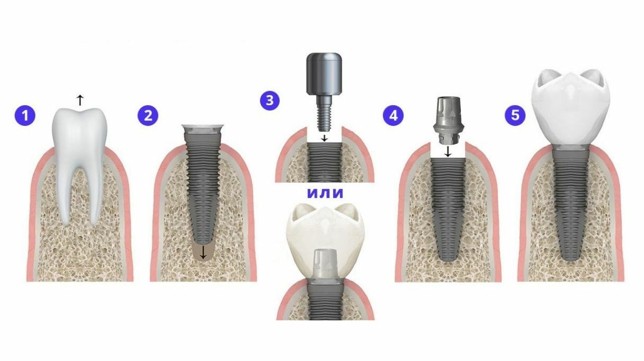 Имплант этапы. Одномоментная имплантация зубов этапы. Этапы имплантации зуба абатмент. Этапы одномоментной имплантации зуба. Этапы одномоментная имплантация одномоментная.
