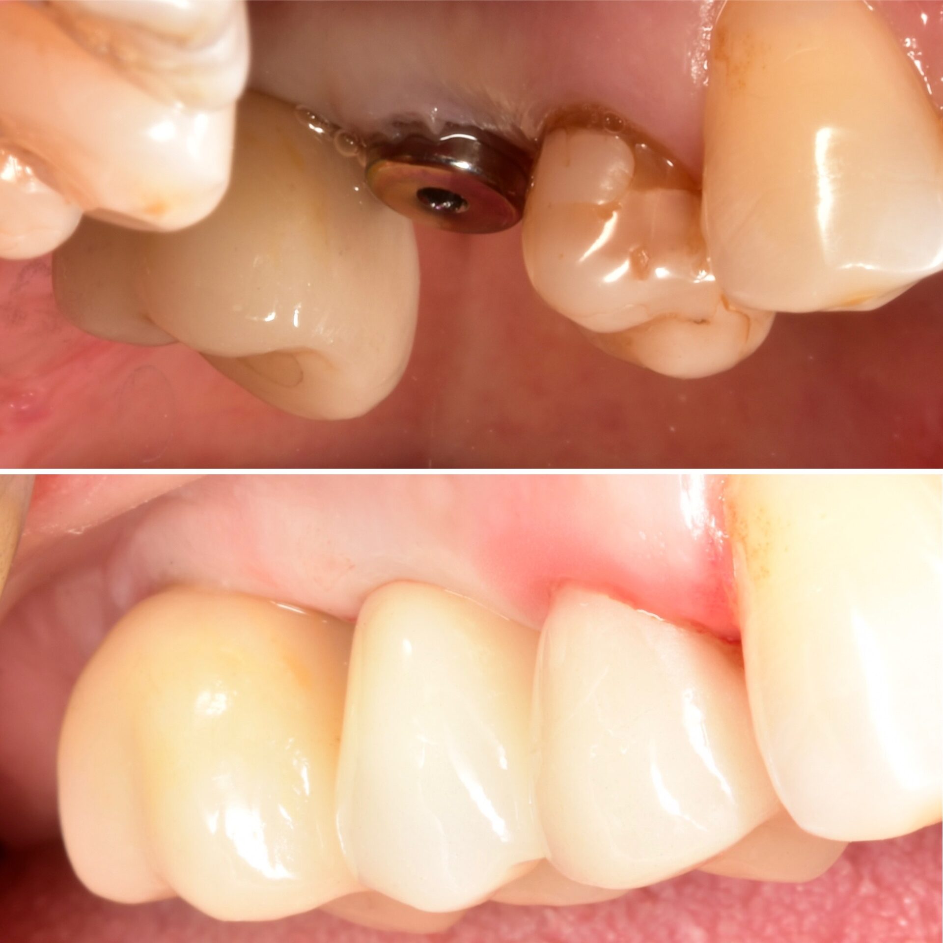 коронки на зубы,керамические коронки в чебоксарах,стоматология чебоксары,стоматология йошкар-ола