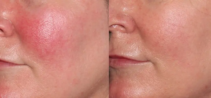 Красные пятна и прыщики на лице: чем опасна розацеа и как с ней бороться?