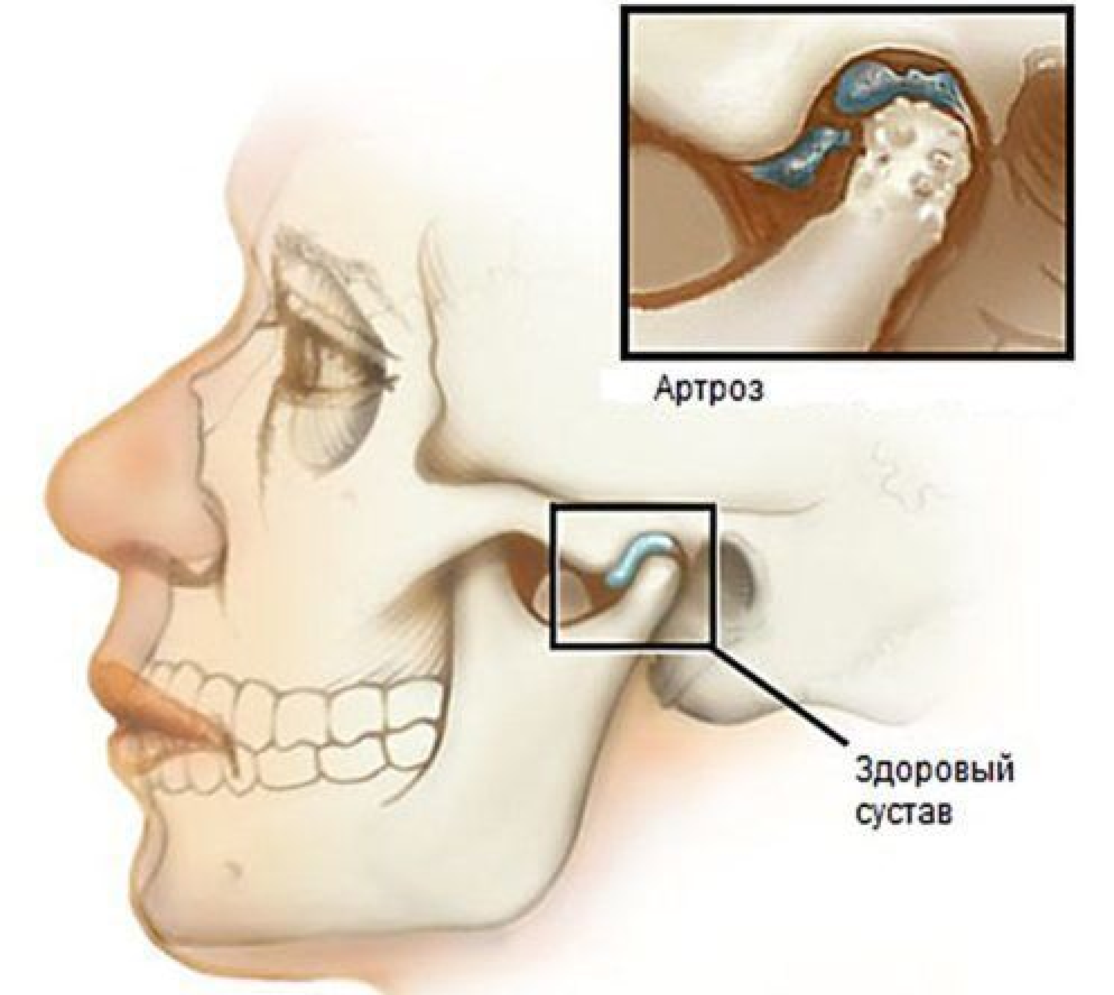 Контрактура жевательных. Артроз височно-нижнечелюстного сустава. Деформирующий остеоартроз ВНЧС кт. Височно-нижнечелюстной артроз.