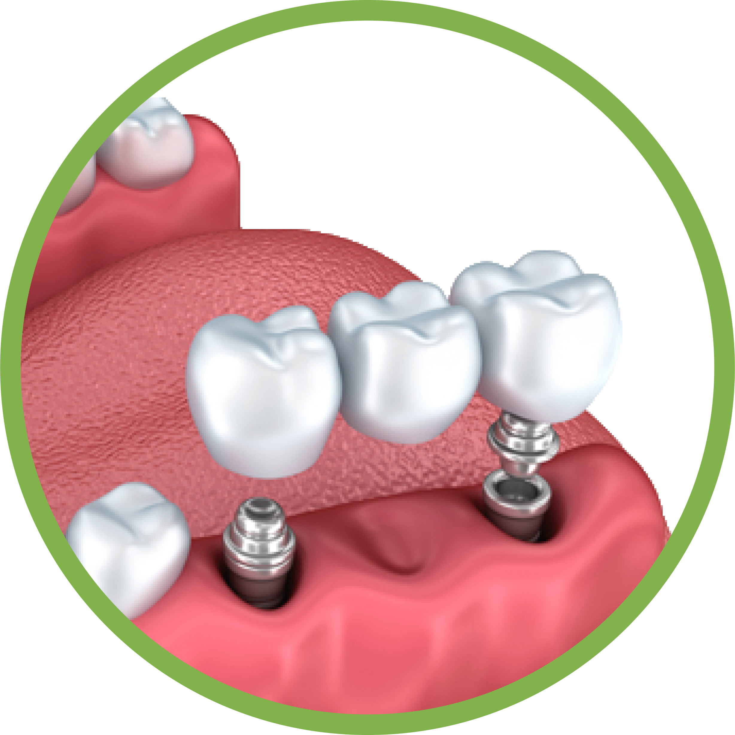 Установка имплантов в Дербенте. Имплантация при отсутствии одного зуба.