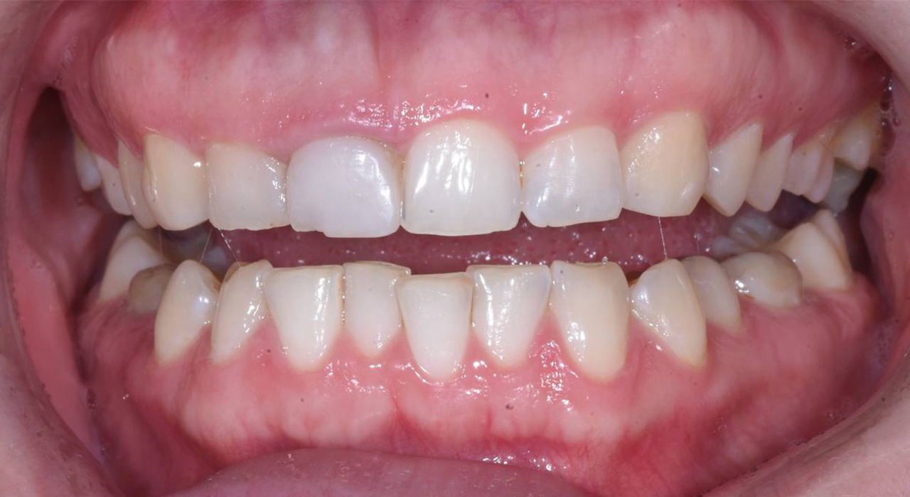 Эстетическое протезирование передней группы зубов коронкой E-max и композитной реставрацией