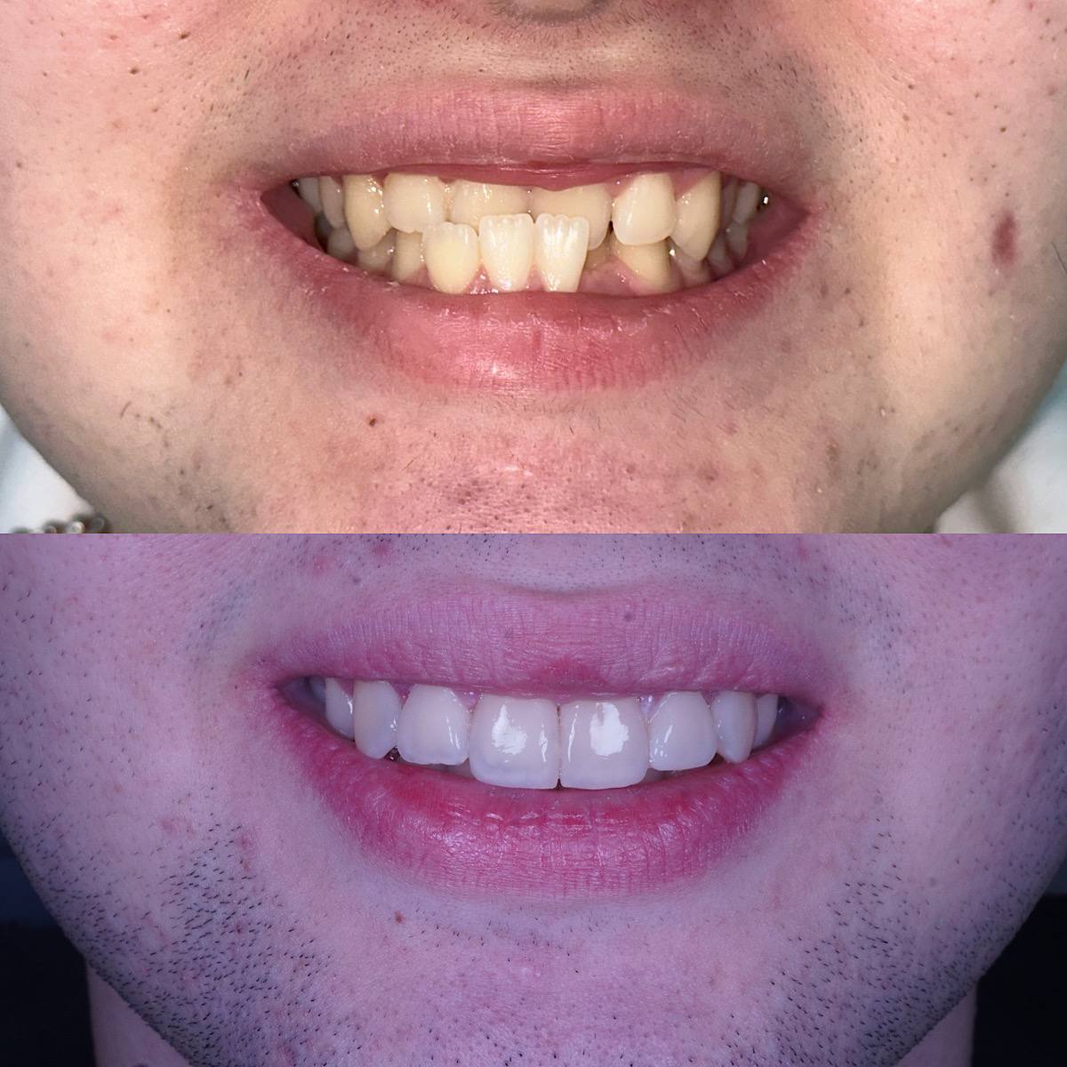 Клинический случай 3, улыбка до и после