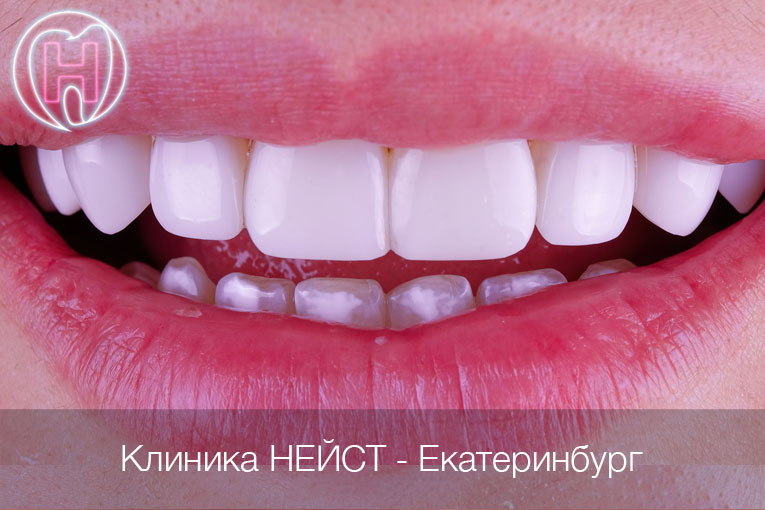 Композитные виниры Стандарт в Екатеринбурге, цвет Блич 3