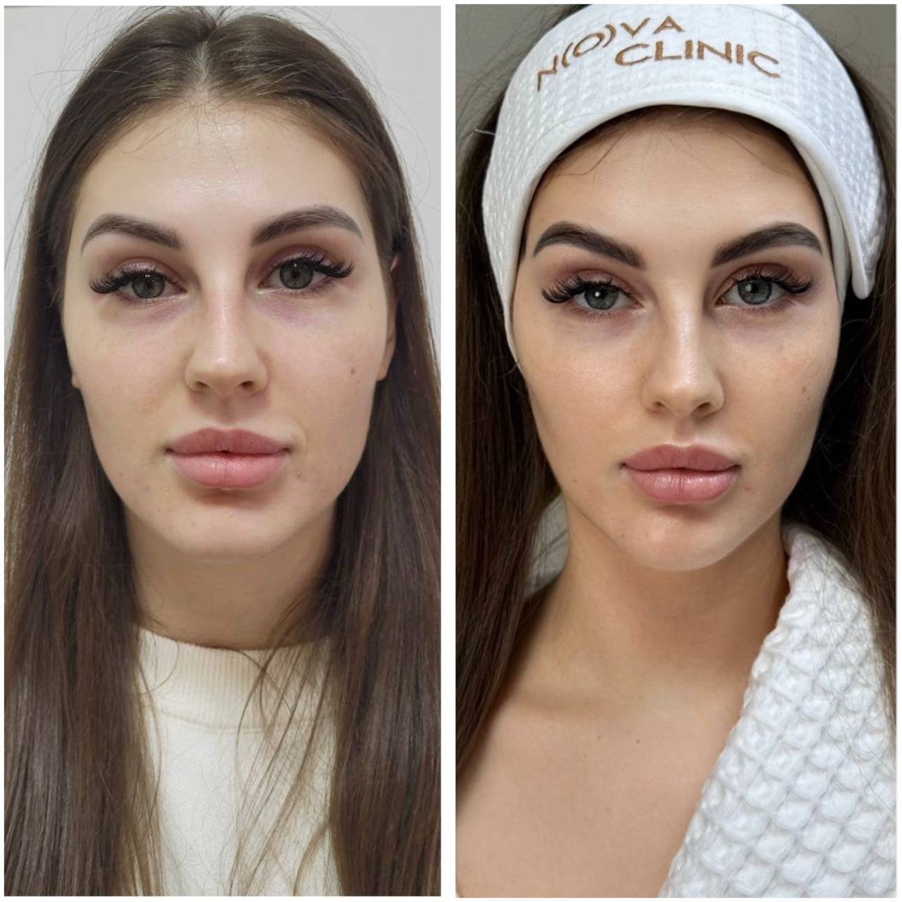 Микротоковый лифтинг Biolift для лица