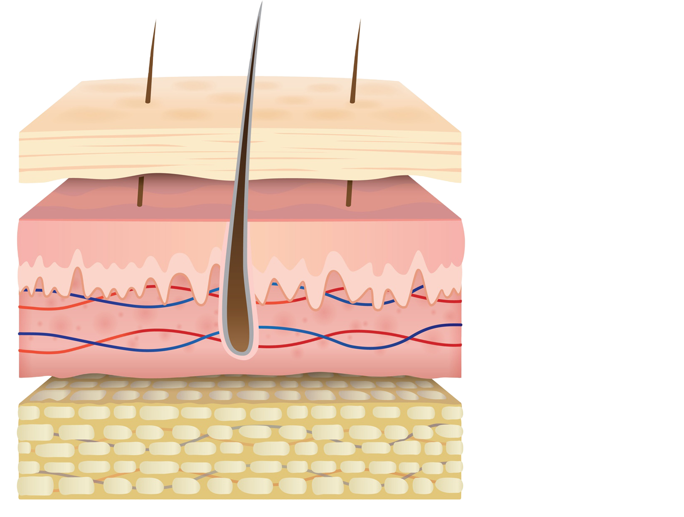 Дерма пронизана. Skin layers. Результаты фракционного лазера пост - акне.