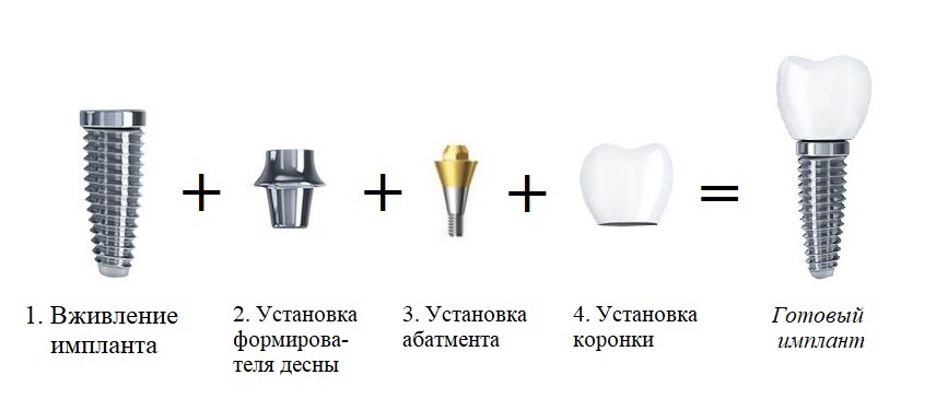 Имплантация схема установки зубов