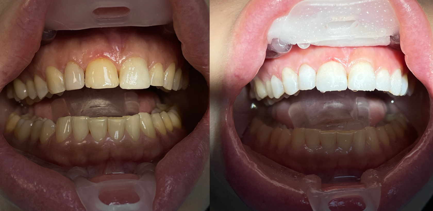 1️⃣ Ламинирование зубов Алматы | Клиника «Dental Center»