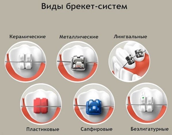 Н систем. Брекеты виды систем h4. Брекет системы h4 коробка.