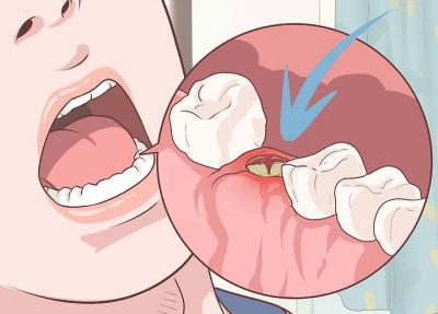 После удаления зуба остался осколок в десне — что делать?