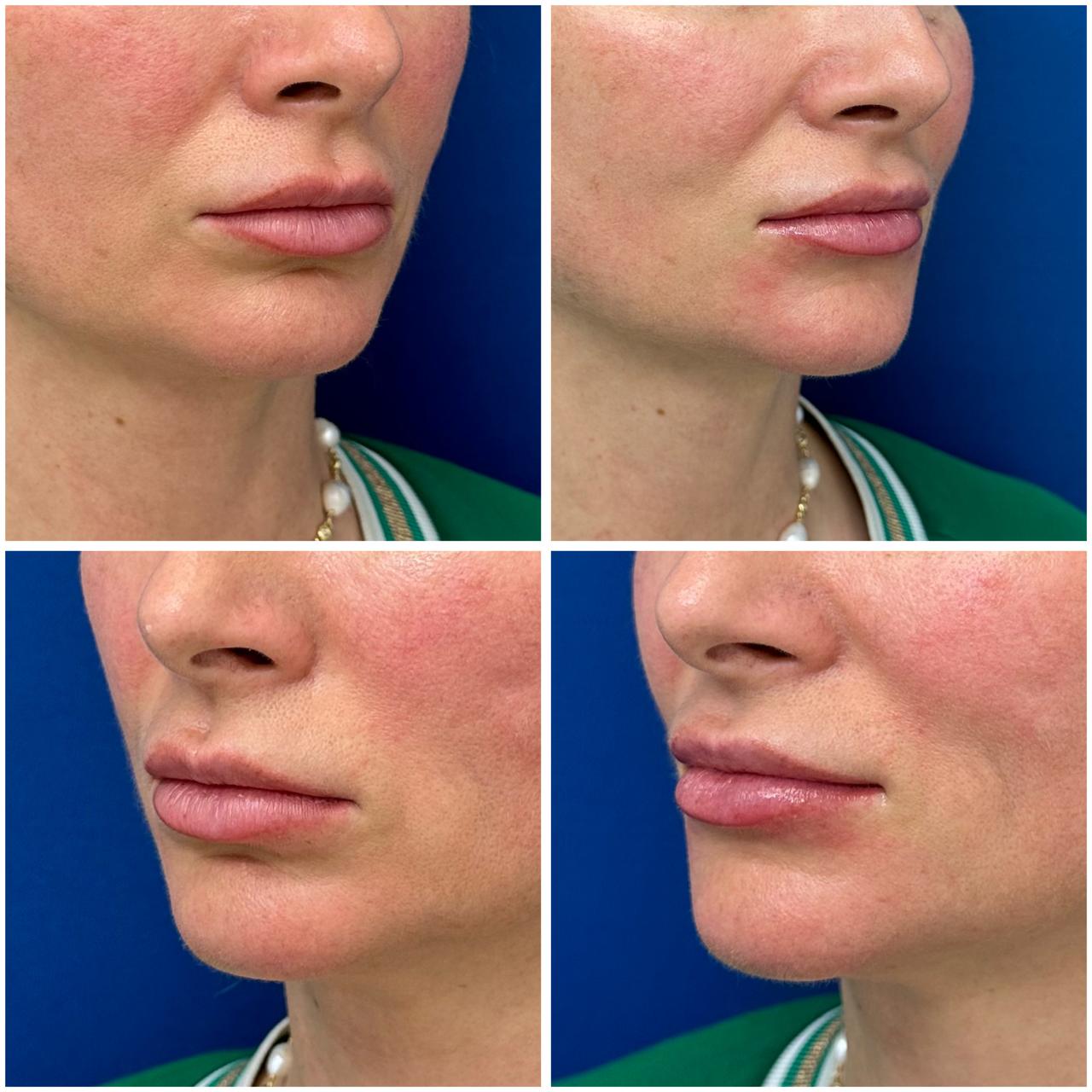 Фото до и после: V-lifting в клинике PradusCOSMO, Санкт-Петербург. Безоперационное омоложение и восстановление овала лица