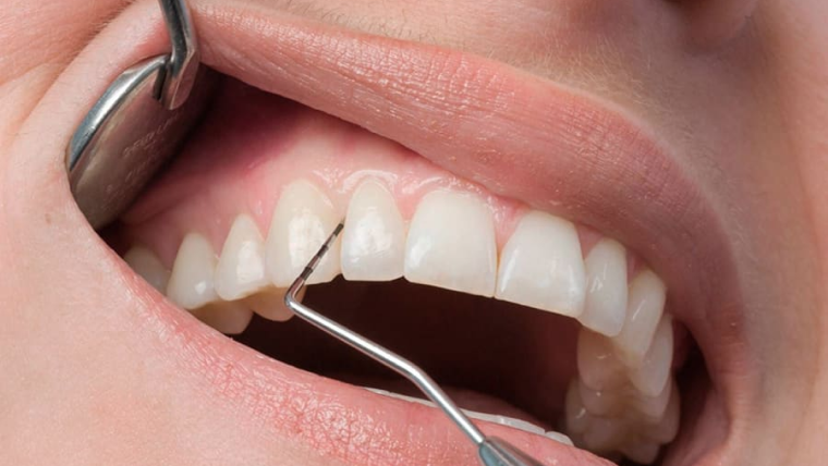 Кюретаж десен — цены и отзывы в Дербенте. Стоматология DK